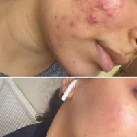 هرگز بوتاکس نکنید|آرایشی، بهداشتی، درمانی|تهران, ولنجک|دیوار