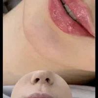 تخفیف فیلر و بوتاکس