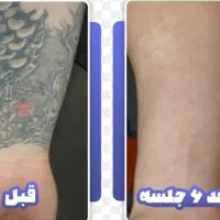 از بین بردن عمیق ترین تاتو ها و روشن کننده کل بدن