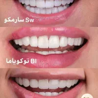 عصب کشی ترمیم کامپوزیت