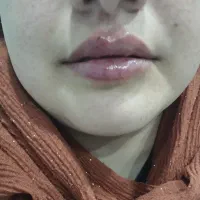 جشنواره عیدانه تزریق ژل و بوتاکس و لاغری در کلینیک|خدمات زیبایی و سلامت|تبریز, |دیوار