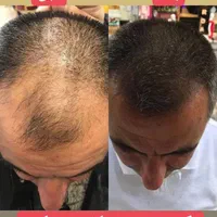 مشاوره ریزش مو و رویش مجدد|خدمات آرایشگری و زیبایی|مشهد, کلاهدوز|دیوار