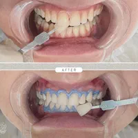 سفیدکردن دندان. بیلیچینگ|خدمات آرایشگری و زیبایی|مشهد, هفت تیر (نه دره)|دیوار