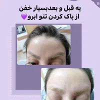 پاک کردن  وریموتاتو بدن و ابرو با لیزر کیوسوئیچ|خدمات آرایشگری و زیبایی|اصفهان, نقش جهان|دیوار