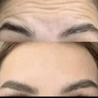 مدل جهت ژل وبوتاکس وانزیم|خدمات آرایشگری و زیبایی|نهاوند, |دیوار