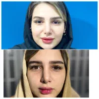 مرکز تخصصی بلفاروپلاستی مشهد ، جراحی پلک مشهد|خدمات آرایشگری و زیبایی|مشهد, احمدآباد|دیوار