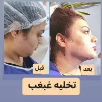 جشنواره ساکشن  غبغب،تزریق چربی ،بوتاکس ، هایفو ونخ