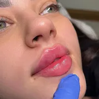 لیفت صورت بانخ ،فیلر ،بوتاکس،مزوتراپی ،پی ارپی