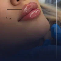 تخفیفات ویژه فیلر،‌بوتاکس،مزو،سابسیژن توسط پزشک