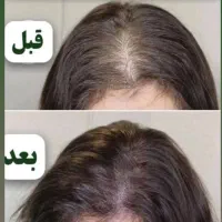 بوتاکس زیر بغل مزوی موجوانسازی صورت زاویه و ساکشن
