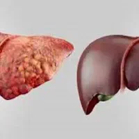 کبدچرب مرگ خاموش از این آگهی راحت رد نشو