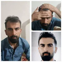 کاشت مو طبیعی،ابرو،و ریش بدون ورم و حتی کبودی|خدمات آرایشگری و زیبایی|یاسوج, |دیوار