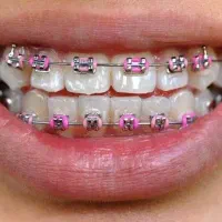 ارتودنسی رایگان کودکان ۶تا ۱۰ سال