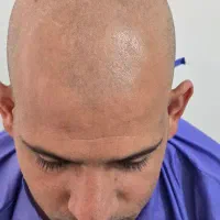 مرکز تخصصی کاشت موی طبیعی رویش طلایی مکران|خدمات آرایشگری و زیبایی|چابهار, |دیوار