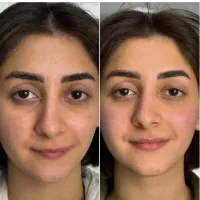 زیبایی لیفت بلفارو فرم بینی بوتاکس نخ ابروزاویه ژل|خدمات آرایشگری و زیبایی|اصفهان, خانه اصفهان|دیوار