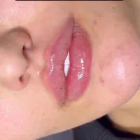 ژل لب فیلر بوتاکس لیزر مو هایفو پی آرپی خال برداری|خدمات آرایشگری و زیبایی|مشهد, آزادشهر|دیوار
