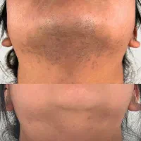 جشنواره تخفیفی لیزر موهای زائد (فقط499)