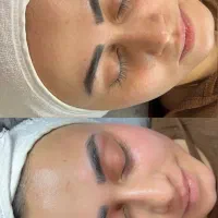 فیشالفیشیالپاکسازیپوستکربوکسیاسیدتراپیاموزش