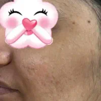 اصلاح درما پیلینگ