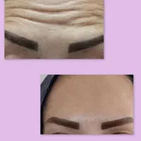 تزریق تخصصی ژل لب تزریق بادی لیفت نخ و چربی|خدمات آرایشگری و زیبایی|خرمشهر, |دیوار