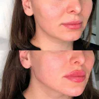 تخفیف ویژه ژل لب، بوتاکس، خط خنده ،گونه زاویه سازی|خدمات آرایشگری و زیبایی|پرند, فاز ۵|دیوار