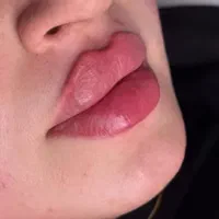 ژل بوتاکس سی سی 500
