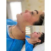 تزریق چربی و‌تخلیه غبغب به روش زاویه سازی