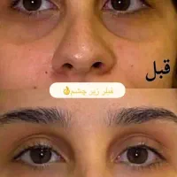 لیفت جراحی بینی بلفارو ژل لب بوتاکس مزو فشیال|خدمات آرایشگری و زیبایی|شاهین‌شهر, طالقانی|دیوار