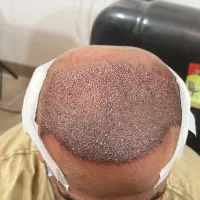 درمان ریزش مو در یک جلسه