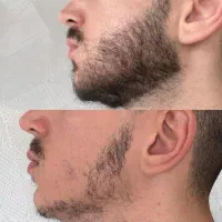 درمان کم‌پشتی *مو و ریش*