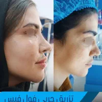 طرح اقساطی ویژه تزریق فول فیس فیلر/بایوفت و نانوفت|خدمات آرایشگری و زیبایی|مشهد, هنرستان|دیوار