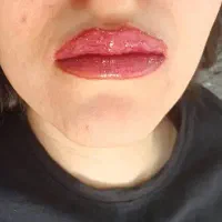 میکروبلیدینگ، فیبروز،شیدینگ لب باتخفیفات ویژه