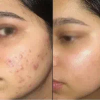 پاکسازی سوپرفشیال تخصصی، مطب ویژه آقایان وبانوان|خدمات زیبایی و سلامت|تهران, نارمک|دیوار