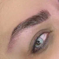 شیدلب بدون بی‌حسی  ریموو یک‌جلسه‌ای قائمشهر