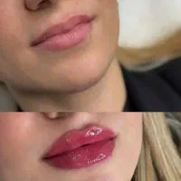 مناسب ترین قیمت فیلر جوانساز‌و فیلر بادی توسط پزشک