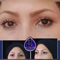 مرکز فوق پیشرفته بلفاروپلاستی لیزری مشهد/بادستگاه