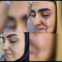 درمان تک جلسه ای تضمینی کک و مک ،لک،اسکار ،جوش|خدمات آرایشگری و زیبایی|قزوین, |دیوار