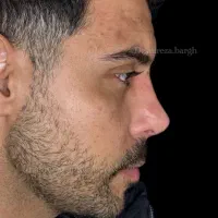 جشنواره تابستانه عمل جراحی بینی بدون تامپون/لیفت|خدمات زیبایی و سلامت|کرج, اصفهانیها|دیوار