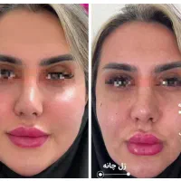 مرکز تخصصی فرم دهی و‌لیفت بینی و صورت با نخ و‌ژل|خدمات آرایشگری و زیبایی|مشهد, احمدآباد|دیوار