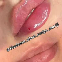 50 درصد تخفیف تزریقات ژل و بوتاکس|خدمات آرایشگری و زیبایی|اهواز, کوی رمضان|دیوار