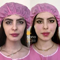 تزریق چربی صورت ماندگاری دائمی روی دست بیکینی باسن|خدمات آرایشگری و زیبایی|تهران, صادقیه|دیوار
