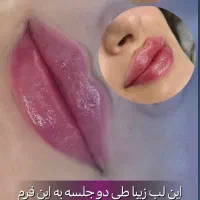 جشنواره تزریق چربی و فیلر به مناسبت روز دختر|خدمات آرایشگری و زیبایی|مریوان, |دیوار