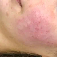 سابسیژن بافت اسکار|خدمات آرایشگری و زیبایی|ایلام, |دیوار