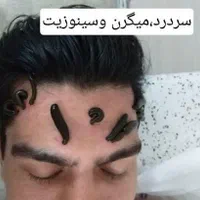 حجامت طبی سوزنی امبدینگ زالودرمانی زگیل تناسلیhpv|خدمات آرایشگری و زیبایی|اصفهان, بهارستان (مخابرات)|دیوار