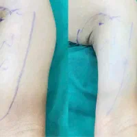 تخفیف خاص لیپوساکشن فیلر بوتاکس|خدمات آرایشگری و زیبایی|کرمانشاه, |دیوار