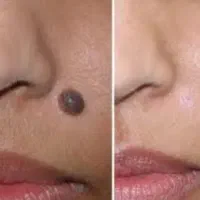 برداشتن خال های گوشتی و انجام تتو بدن و فیبروز