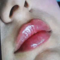 فیلر وبوتاکس مزو تراپی جوان ساز