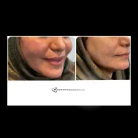 بوتاکس مصپورت فقط۹۰۰،تزریق فیلر وجوانساز توسط پزشک