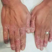 خودایمنی پسو|آرایشی، بهداشتی، درمانی|چالدران, |دیوار