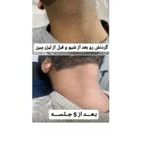 لیزر موهای زائد لیزر آقایان لیزر بانوان آموزش|خدمات آموزشی|اصفهان, بوستان آینه خانه|دیوار